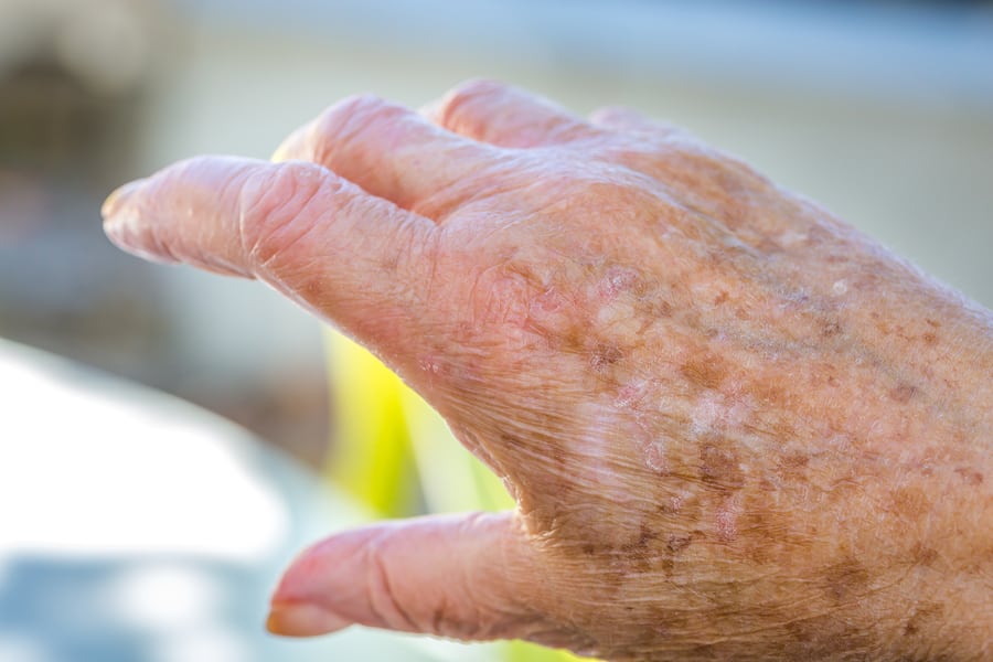 Eczema Changes with Age-Research

Photo Courtesy