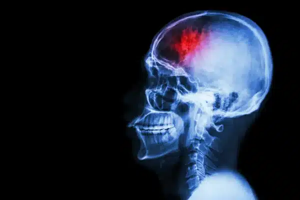 Study Shows Likelihood of Memory and Thinking Problems for Stroke Survivors


Photo Courtesy