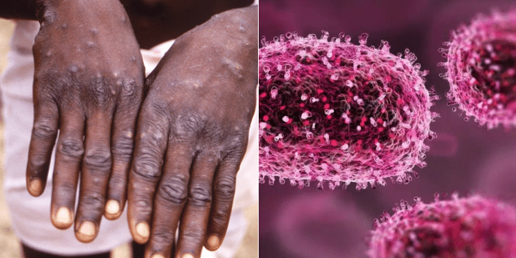 Mpox: What to Watch Out For, Treatment and What to Worry About