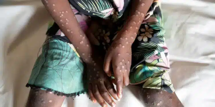 Mpox: Govt Secures Vaccine Doses, Prioritize High-Risk Group
