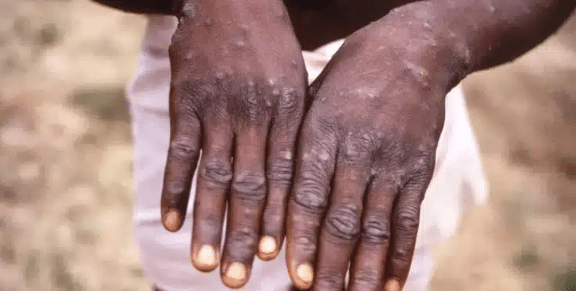 A person with rashes on the skin, a symptom of the Mpox virus. PHOTO/Courtesy