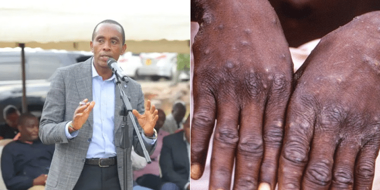 Kiambu County Clarifies Reported Mpox Case