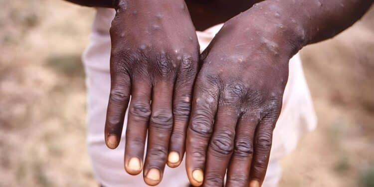 Mpox