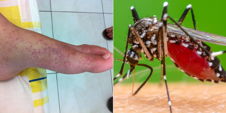 Details of Chikungunya Spreading in Mombasa After Outbreak