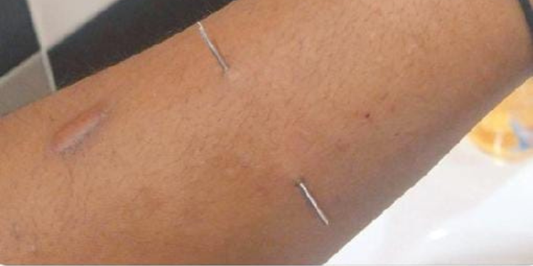 Tattoos &Amp; Piercings Among Kenyan Youth: Art, Identity Or Cultic Symbolism A Hand Piercing